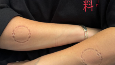 Mysterious bite marks on Billie Eilish's body have Internet concerned