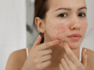 Acne and pimples? Dietary rules to not break in case of acne