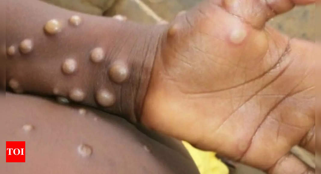 MPOX Virus: 'Most Deadly' MPOX Variant Spreads in Several African Countries, Know Signs and Symptoms |