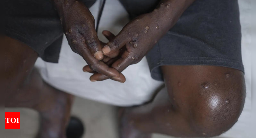 WHO declares mpox a global health emergency: What is mpox, can the virus spread, How can it be stopped – Times of India