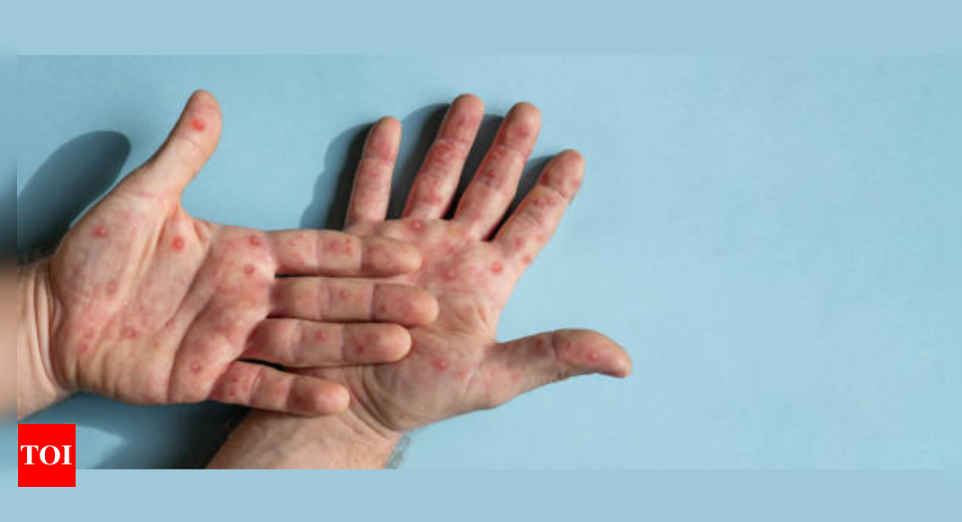 Symptoms of the monkeypox virus: Monkeypox virus detected in Pakistan: 3 cases identified so far |