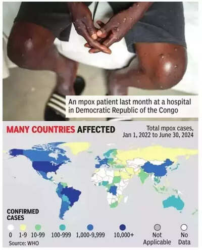 8. Why Mpox has triggered second global alert in two years - Times of India