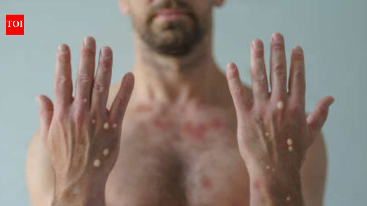 Monkeypox Clade 1B: Monkeypox's new strain Clade 1b is spreading fast ...