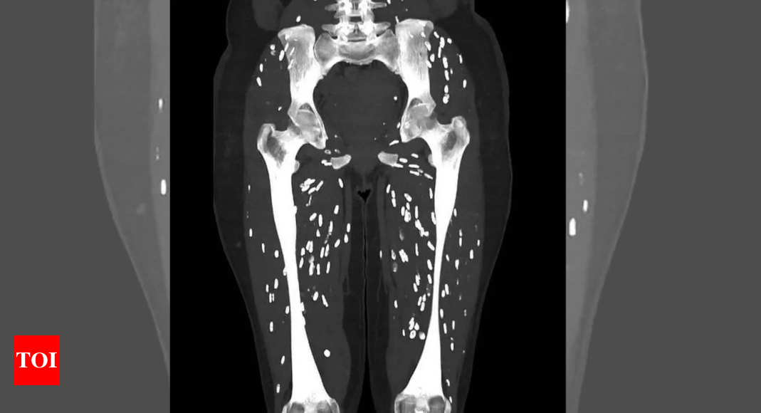 ‘One of the craziest CT scans’: Doctor shares pictures of patient’s legs filled with parasites – Times of India