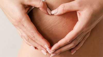 Best home remedies to get rid of stretch marks