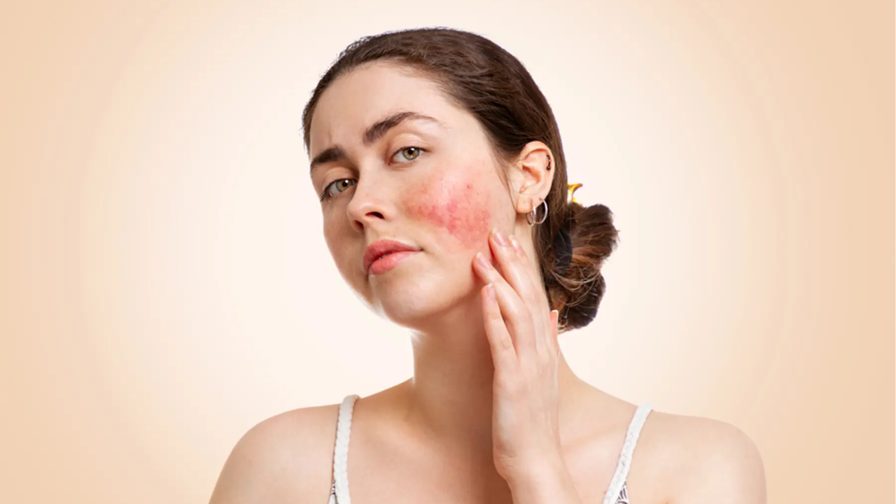 What Does Red Splotches On Your Face Mean - Infoupdate.org