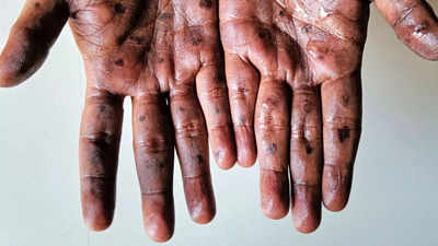 Monkeypox in India: Govt issues advisory to states and UTs on preventing Mpox spread