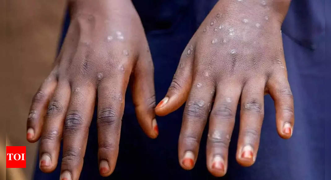 A second Mpox case has emerged in Kerala, prompting the Health Ministry to issue an alert. Important notes on managing Mpox |