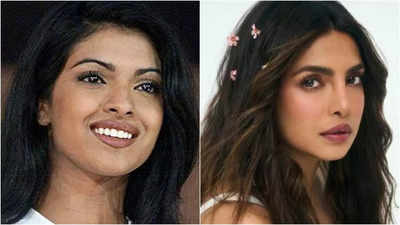 Surgery gone wrong: When Priyanka Chopra’s honest confession on her botched nose surgery reminded of its consequences