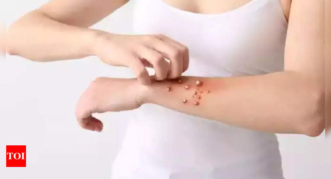 Scabies Outbreak: UK reports spike in Scabies, doctors urge public to shed ‘social stigma’ and come forward | World News – Times of India