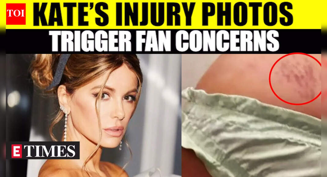 Kate Beckinsale Shares Injury Photos: Fans Express Concern