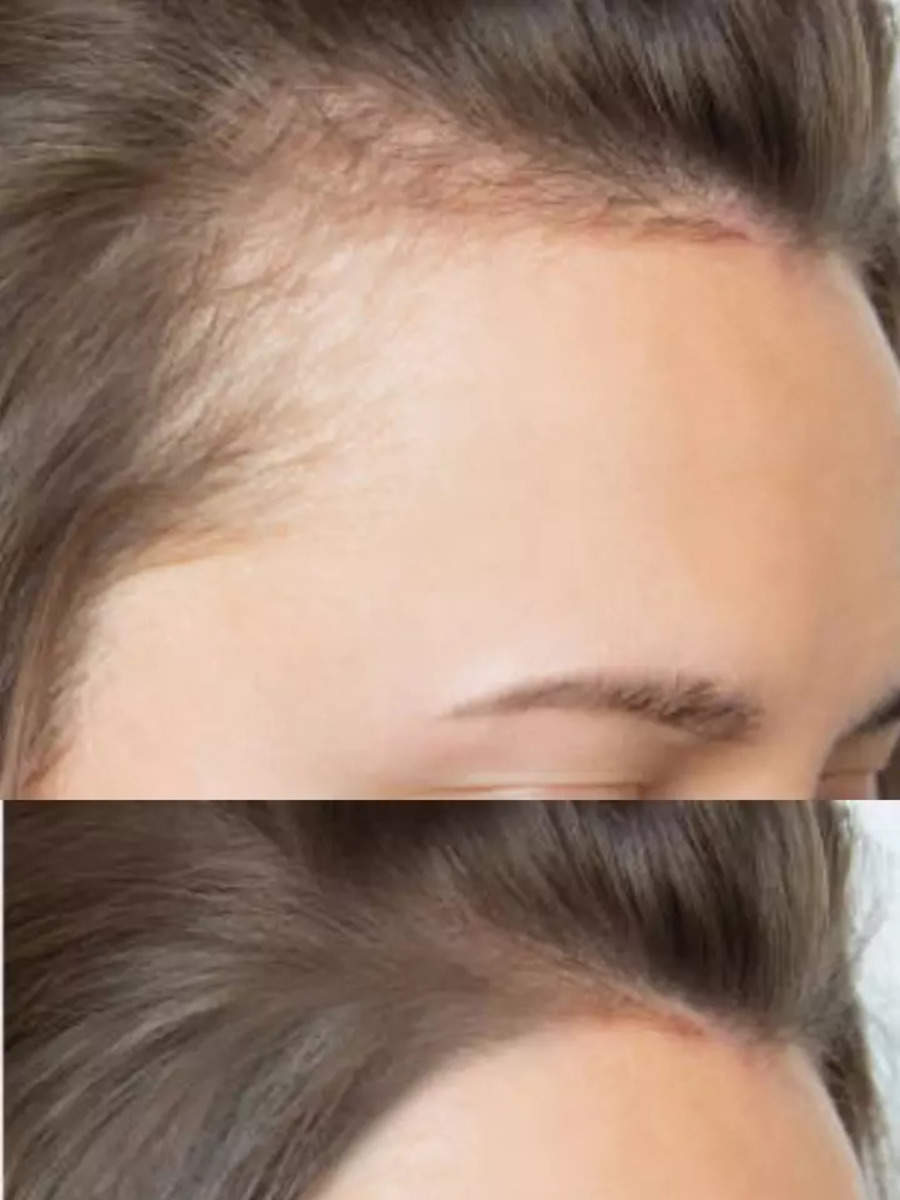 Egg mask to Olive oil: Easy home remedies to reverse balding, boost hair growth