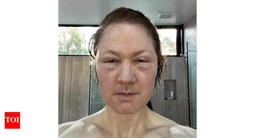 Tech millionaire Bryan Johnson shares photos and accepts 'defeat' with his anti-ageing therapy - Times of India