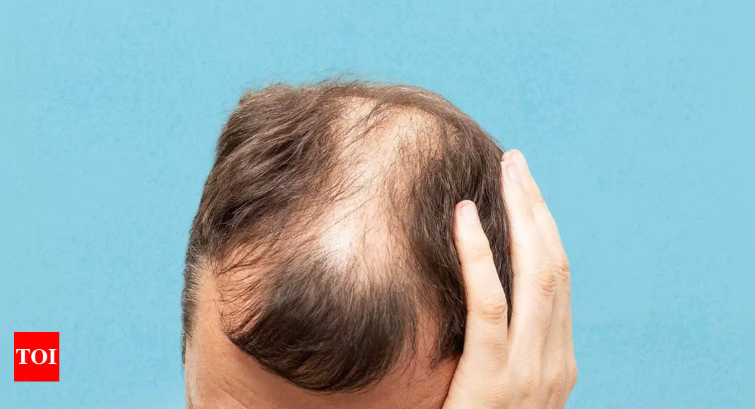 Early balding? 7 unexpected causes of hair loss in 20s