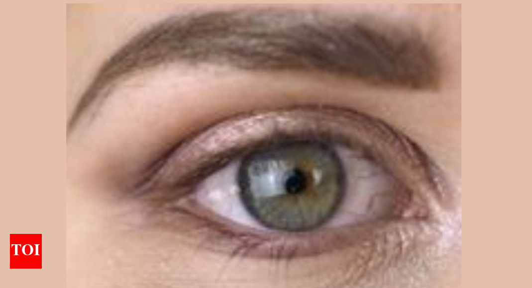 Understanding Keratoconus: Causes, Symptoms, and Early Treatment for Better Eye Health - News Directory 3