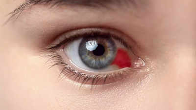 Bleeding eye illness brought about by means of Marbug virus with 50 computer survival price a reason of outrage, spreads thru human touch: Complete document – Instances of India