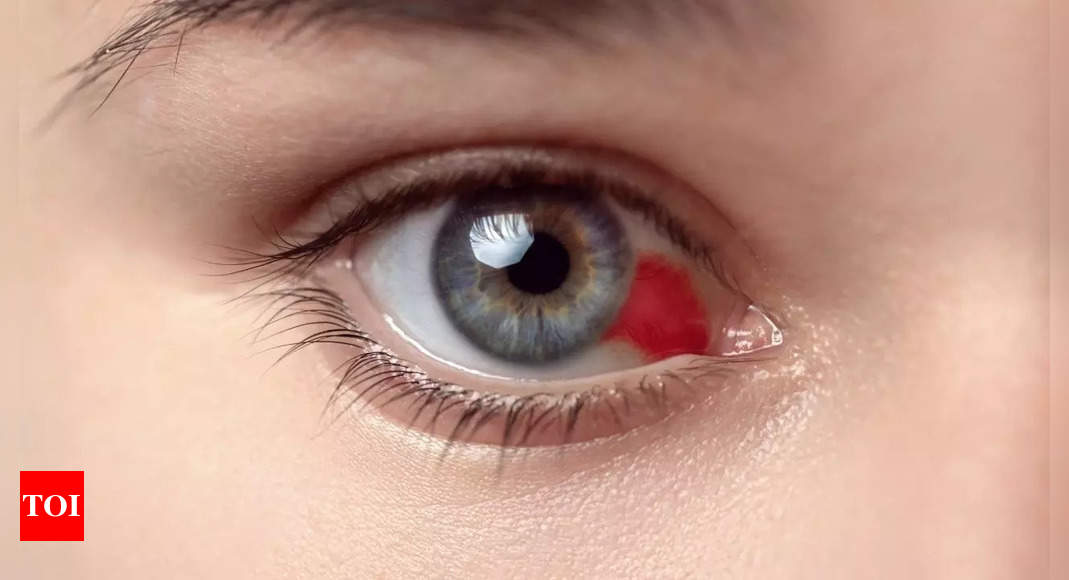 Human contact fuels deadly Bleeding Eye Disease outbreak: What we need to know