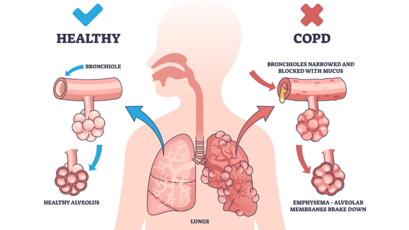 Assess your lung function: Insights about COPD