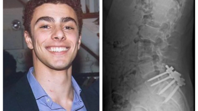 X-ray of Luigi Mangione's 'stapled spine' viral: 'I'd kill someone too if...'