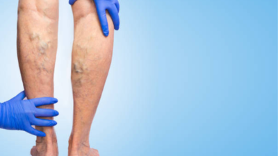 Should you rethink laser treatment for your varicose veins?