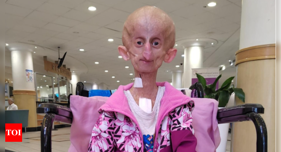 Who was Beandri Booysen? TikTok star died due to rare aging disease 'Progeria'