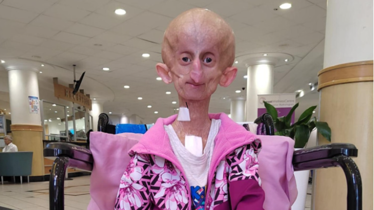 Who was Beandri Booysen? TikTok star died due to rare aging disease 'Progeria' - Times of India