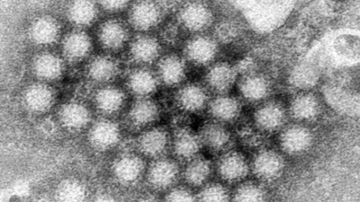 Norovirus instances surge in america: What you want to learn about this abdomen worm – Instances of India