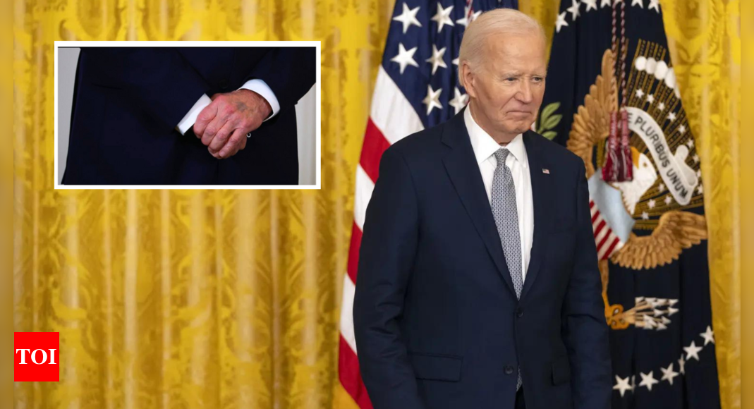 Biden’s mysterious ‘purple bruise’ on left hand sparks online discussion: ‘He is still pumped up by drugs’ | World News – Times of India