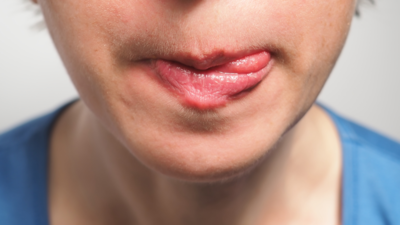 https://static.toiimg.com/thumb/msid-116991854%2Cimgsize-933189%2Cwidth-400%2Cresizemode-4/chapped-2.jpg