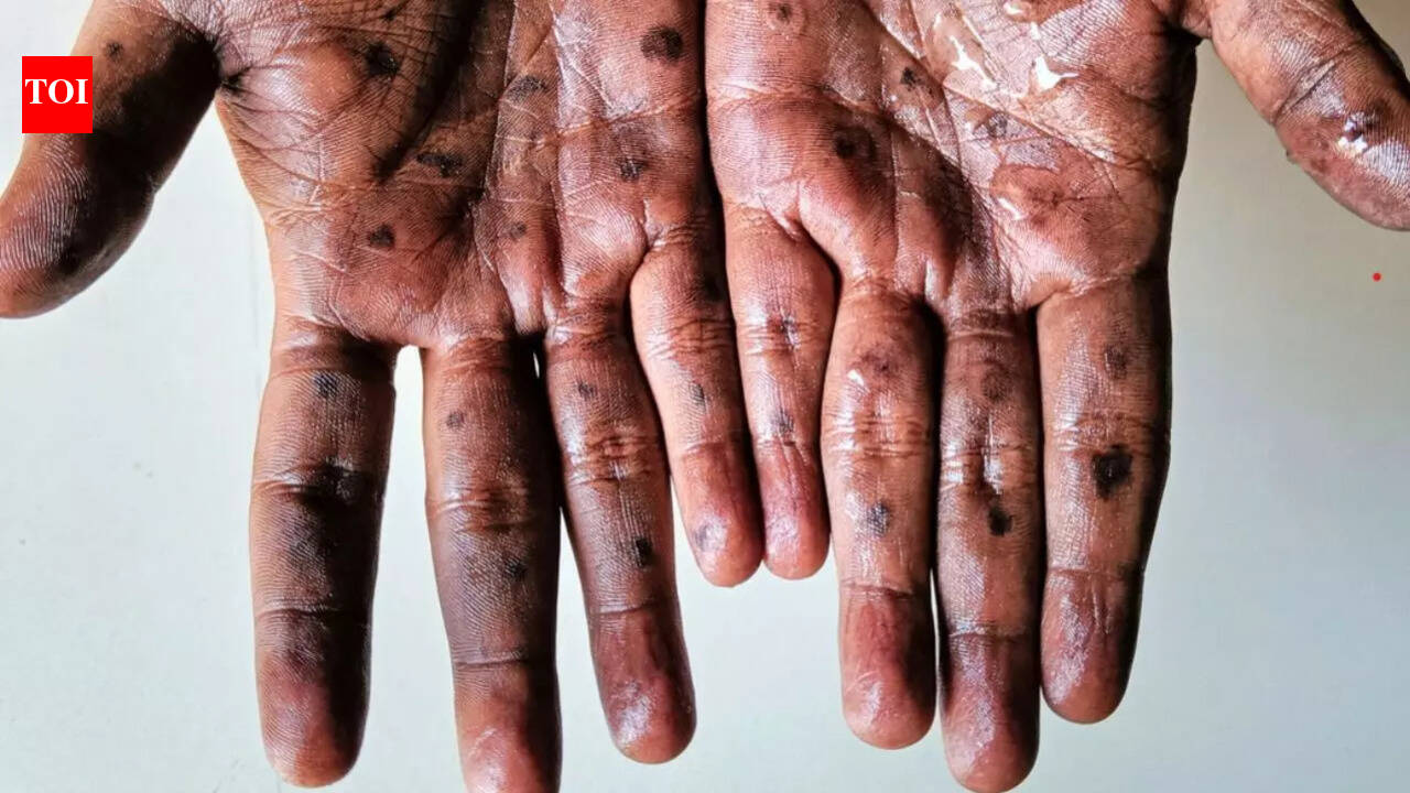 France detects first case of clade 1b Mpox case; know the key symptoms ...