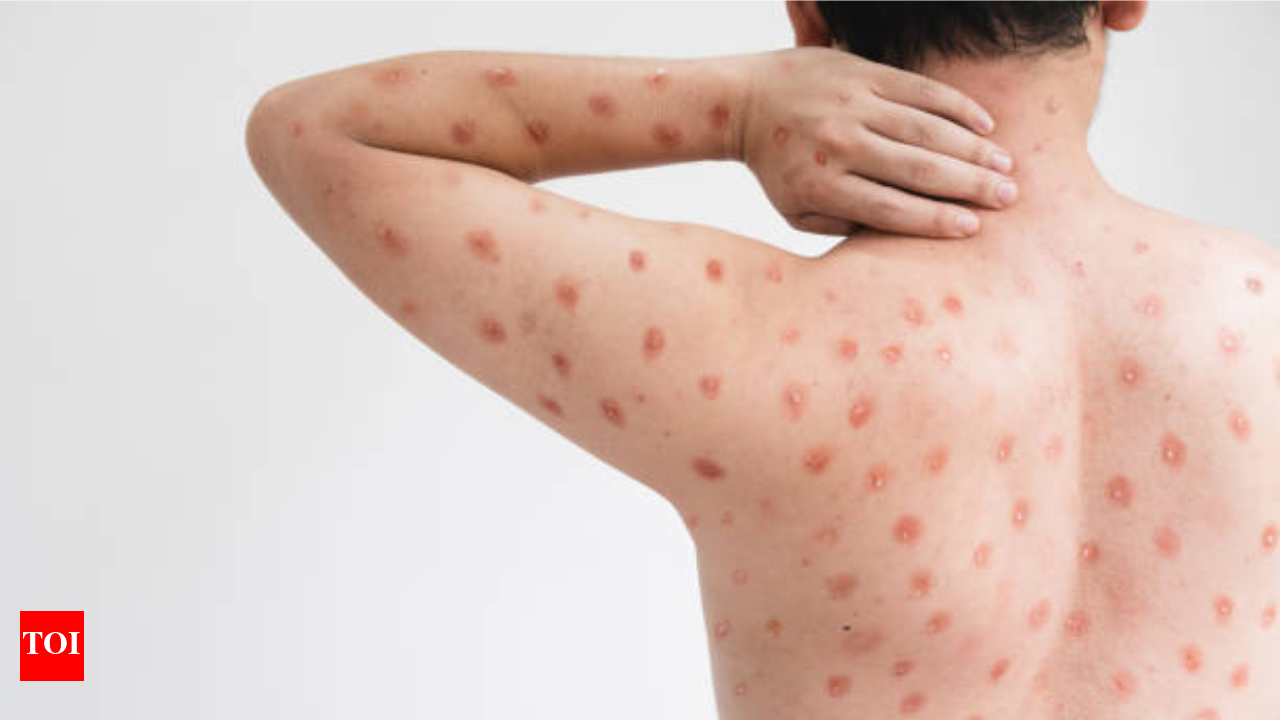 Mpox in China: New mutated strain of mpox virus, clade 1b detected | - The  Times of India