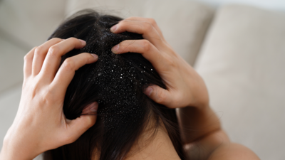 6 dandruff remedies for a squeaky clean scalp