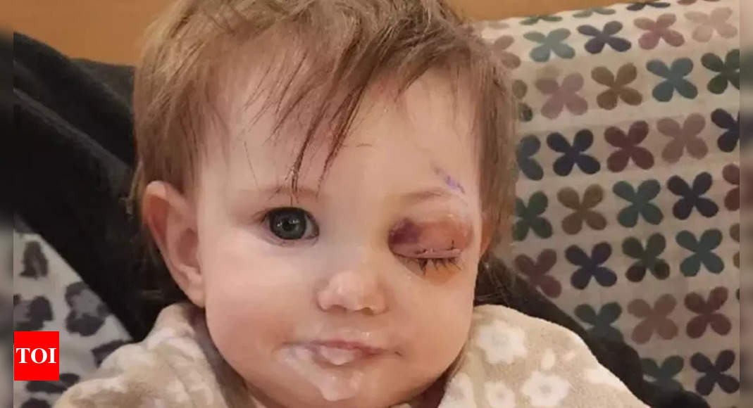 1-year-old loses eye to rare cancer; Early signs you shouldn't ignore