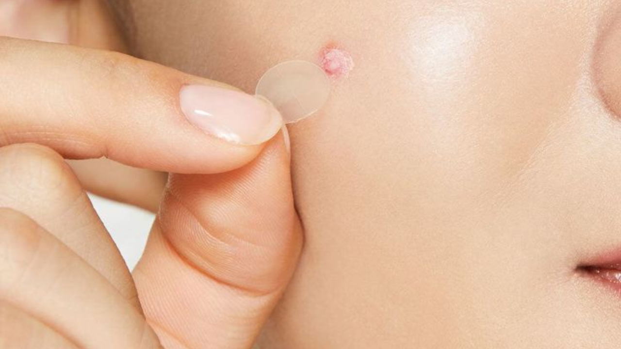 Are silicone patches for your face acne a safe choice? | - The Times of  India