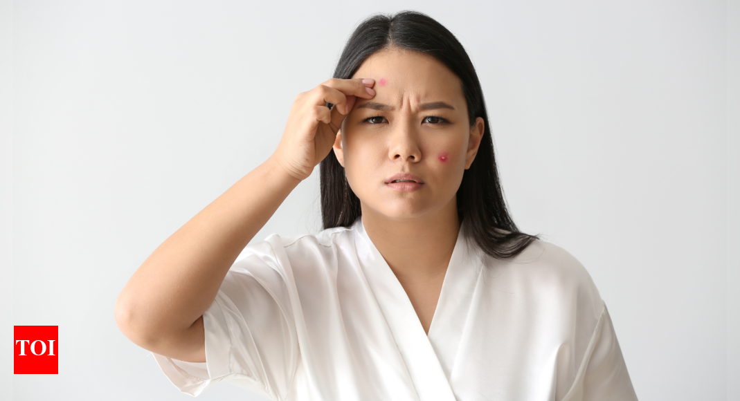 Decoding the acne map: What you pimples and breakouts say about your ...