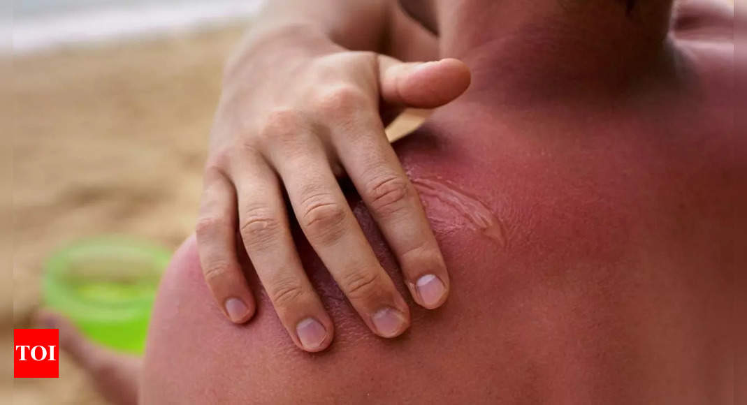 What’s the main cause behind sunburn? Scientists make startling discoveries