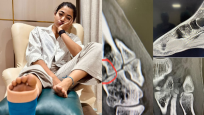 Rashmika Mandanna shares an x-ray of the injured foot; reveals 3 fractures and muscle tear while promoting 'Chhaava'