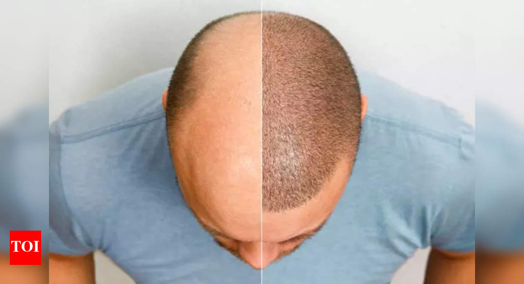 Debunking common myths about hair transplants