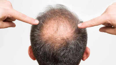 Buldhana hair loss cases: Expert blame high selenium in wheat crop