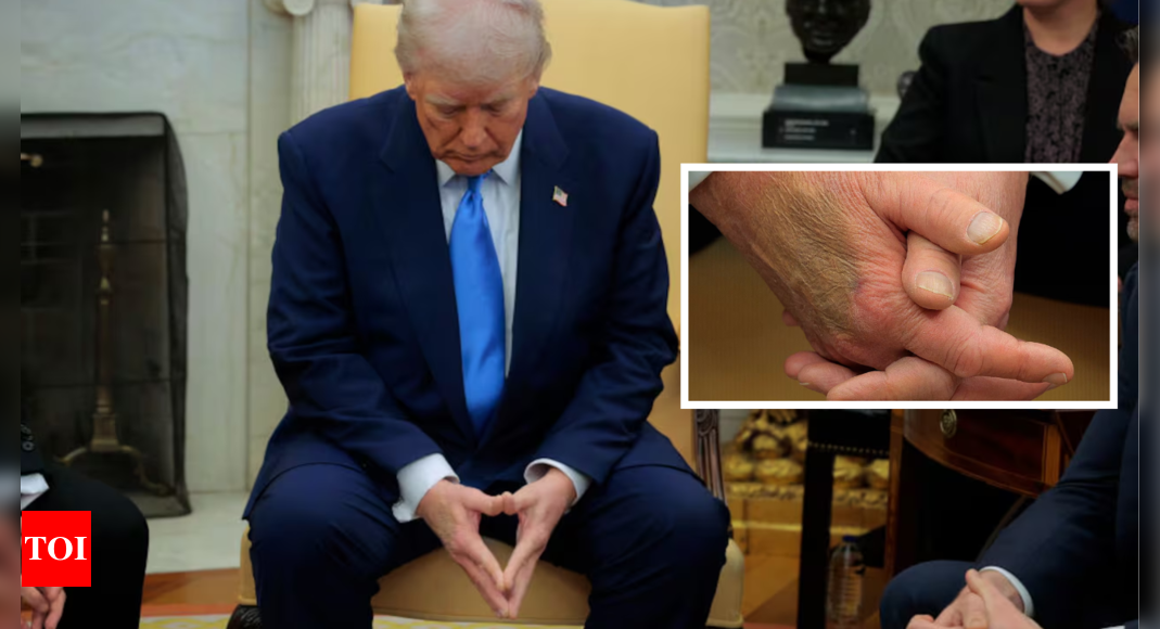 Mysterious bruise on Trump’s hand sparks speculation: What’s the real story?