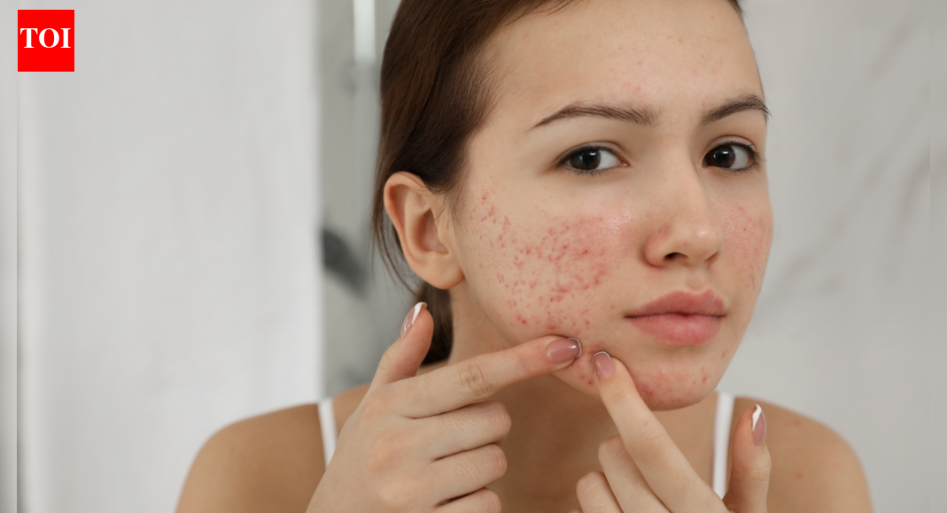 Skin Acne Cause What is the biggest cause of skin acne, dryness and
