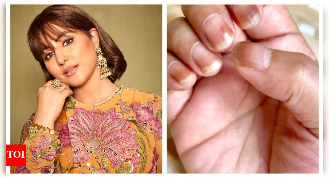 Hina Khan shares photos of her discoloured nails; reveals 'Nail discolouration is one of the most common side effects of chemotherapy'