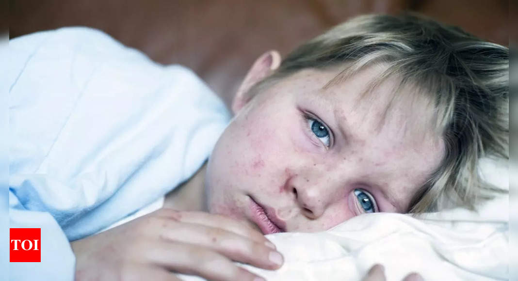 Texas Measles crisis intensifies; children and teens worst affected