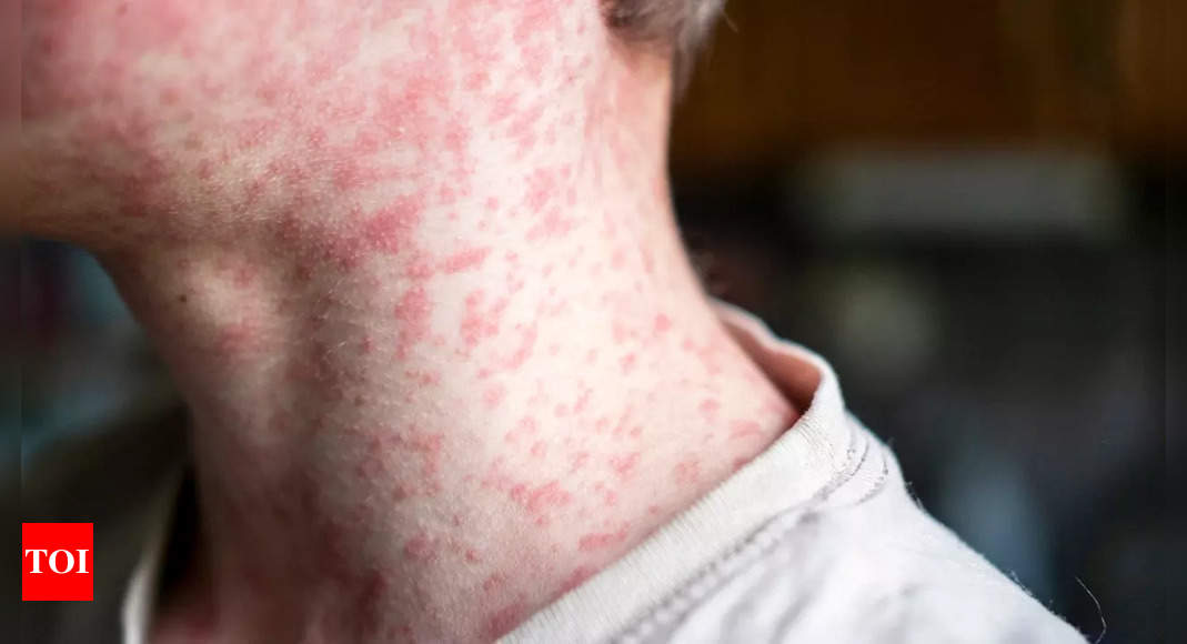 Measles cases on the rise among youngsters in Kansas: How to prevent the disease