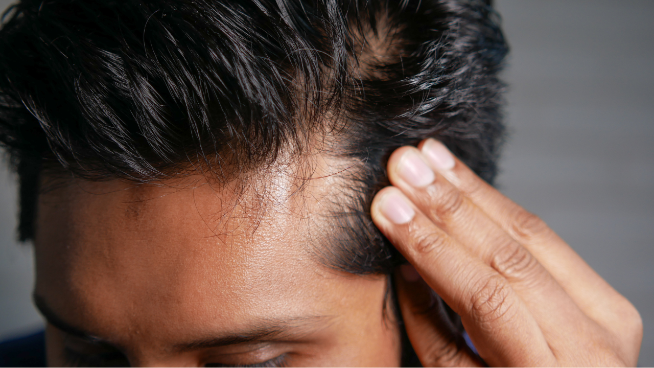 Hair Fall during wedding| Midas Wellness Hub