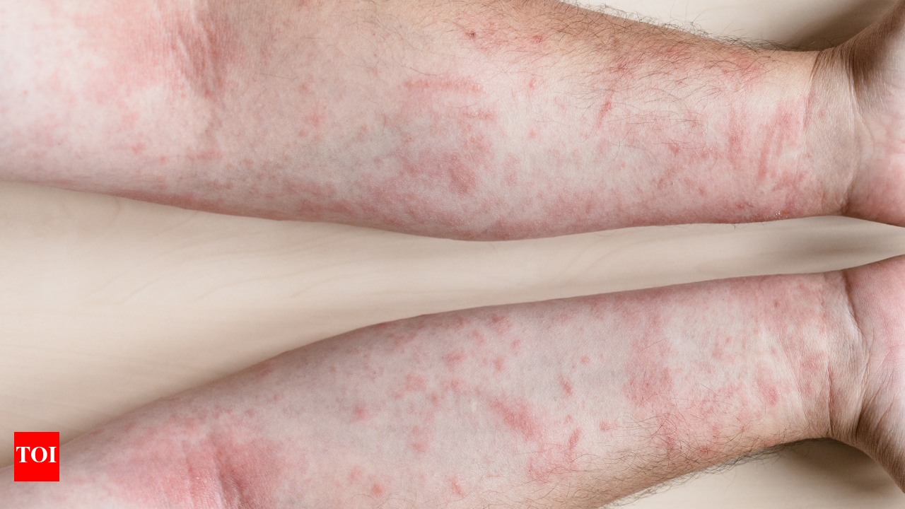 Heat Rash On Legs How Long Does It Last