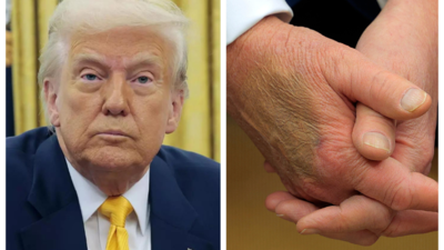 Czy Trump przyjmuje Ozempic? Teorie spiskowe wirują, a tajemnicza plastra skóry pojawia się na jego dłoni