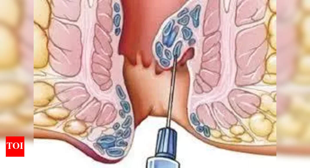 Apollo Spectra Introduces Rafaelo for Haemorrhoid Treatment