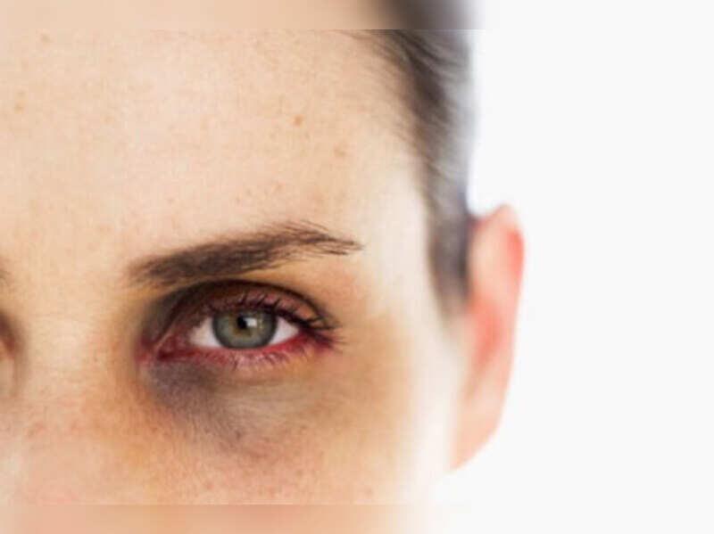 dark circles under eyes treatment at home in marathi