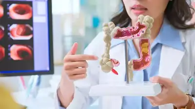 結腸癌の症状：なぜ結腸癌は今あなたの注意に値するのか：これがすべての賢い大人が知っておくべきことです| – インドのタイムズ
